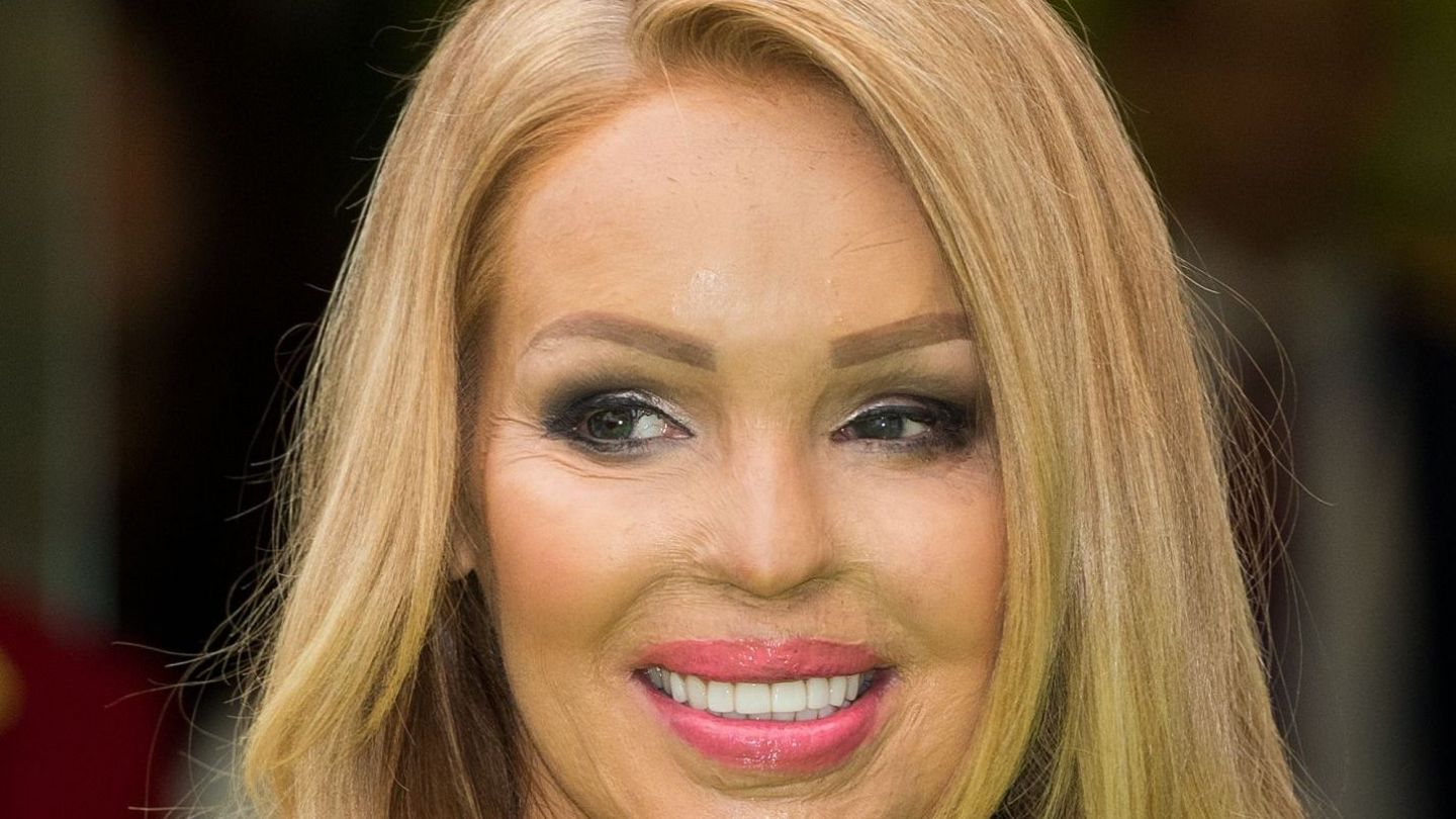 &quot;Sper sa fie ultima operatie&quot;. Ce s-a intamplat cu Katie Piper, femeia care a fost arsa cu acid sufuric pe fata